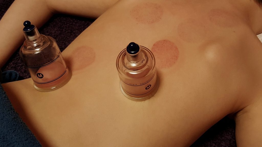 Cupping thérapie