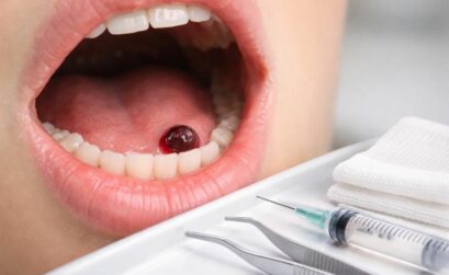 découvrez les traitements efficaces pour soigner une petite boule de sang dans la bouche et soulager l'inconfort rapidement.