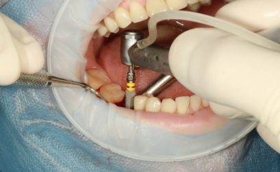 Pose implant dentaire à Paris