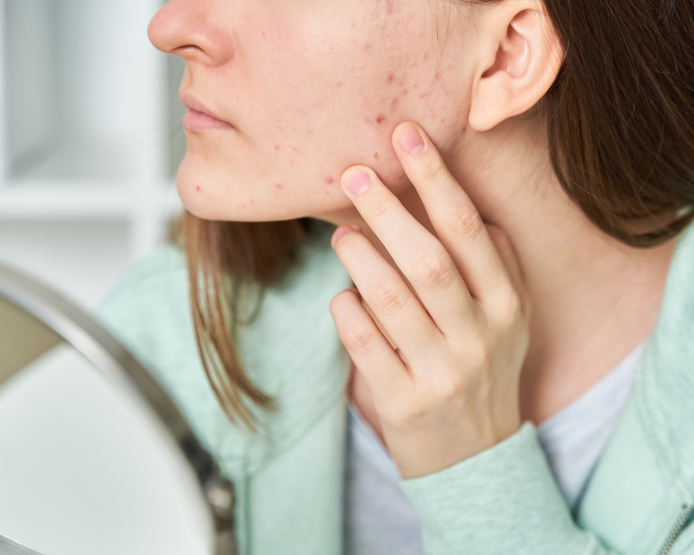 acné sur le visage