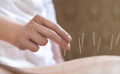 acupuncture