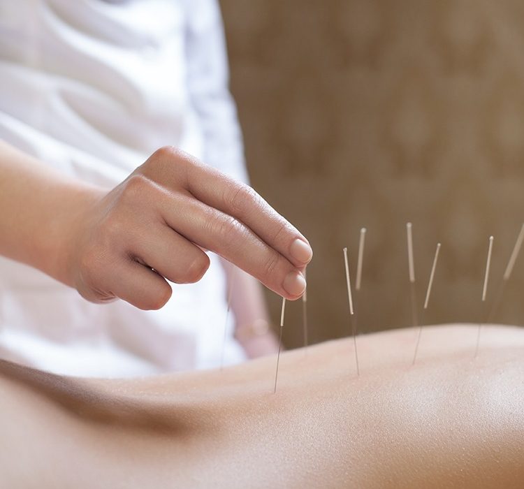 acupuncture