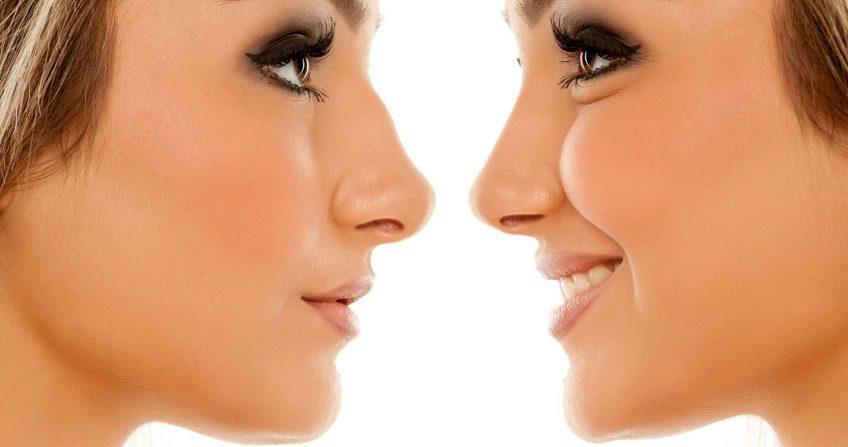 chirurgie esthétique rhinoplastie