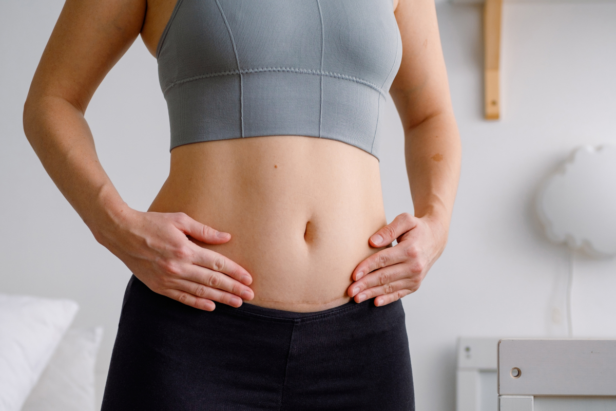 cicatrices après liposuccion