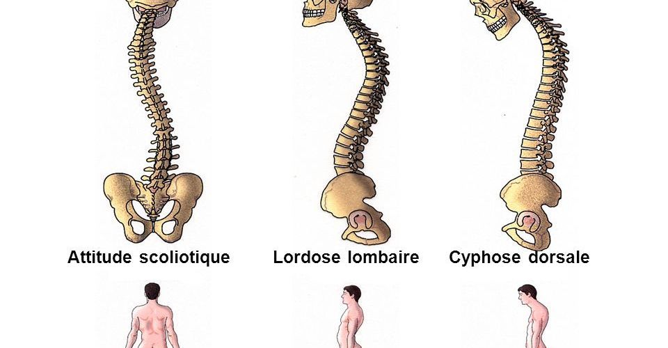 cyphose dorsale