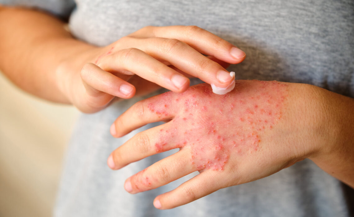 eczéma des mains