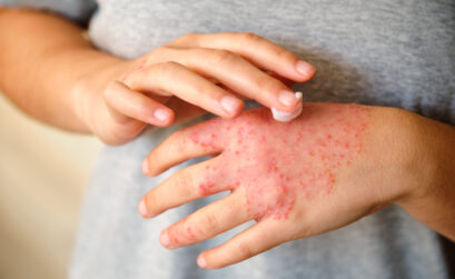 eczéma des mains