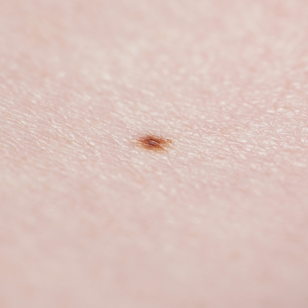 grain de beauté