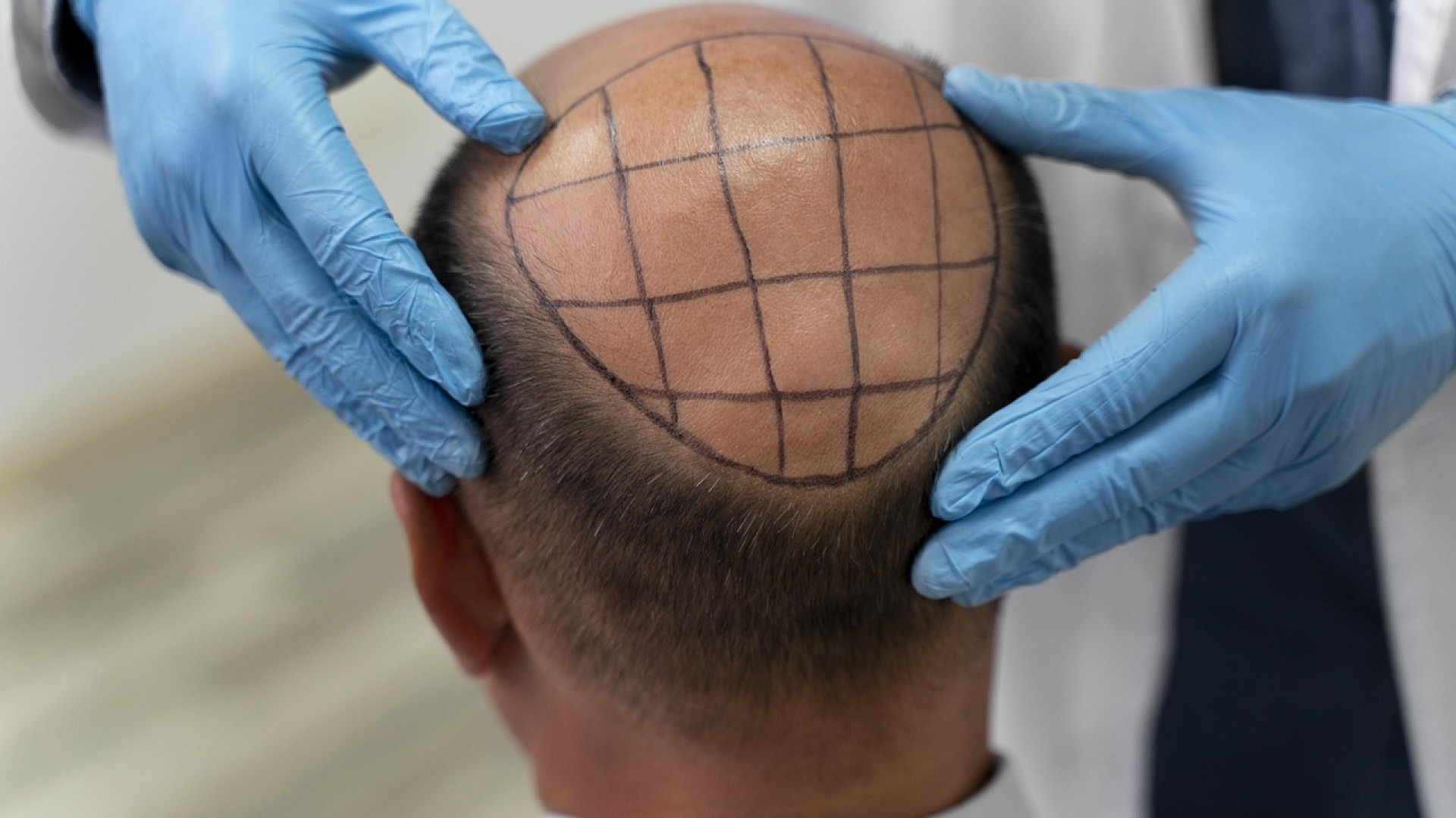La greffe de cheveux : retrouvez confiance en vous grâce à cette solution !