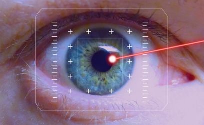 Chirurgie lazer des yeux"Lasik"