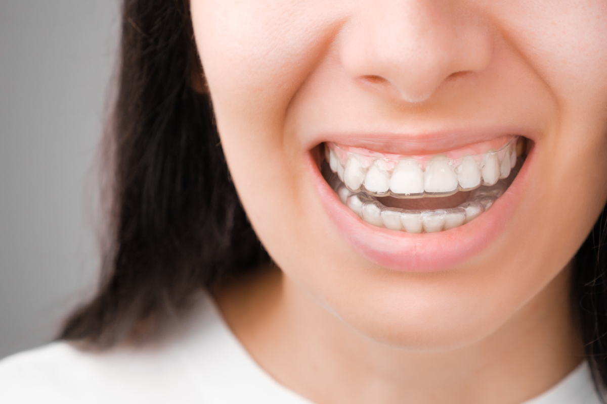 orthodontie adulte