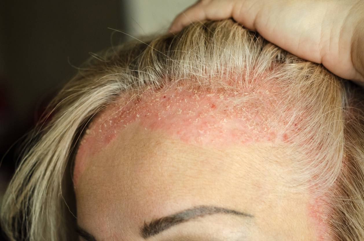 traitement psoriasis du cuir chevelu