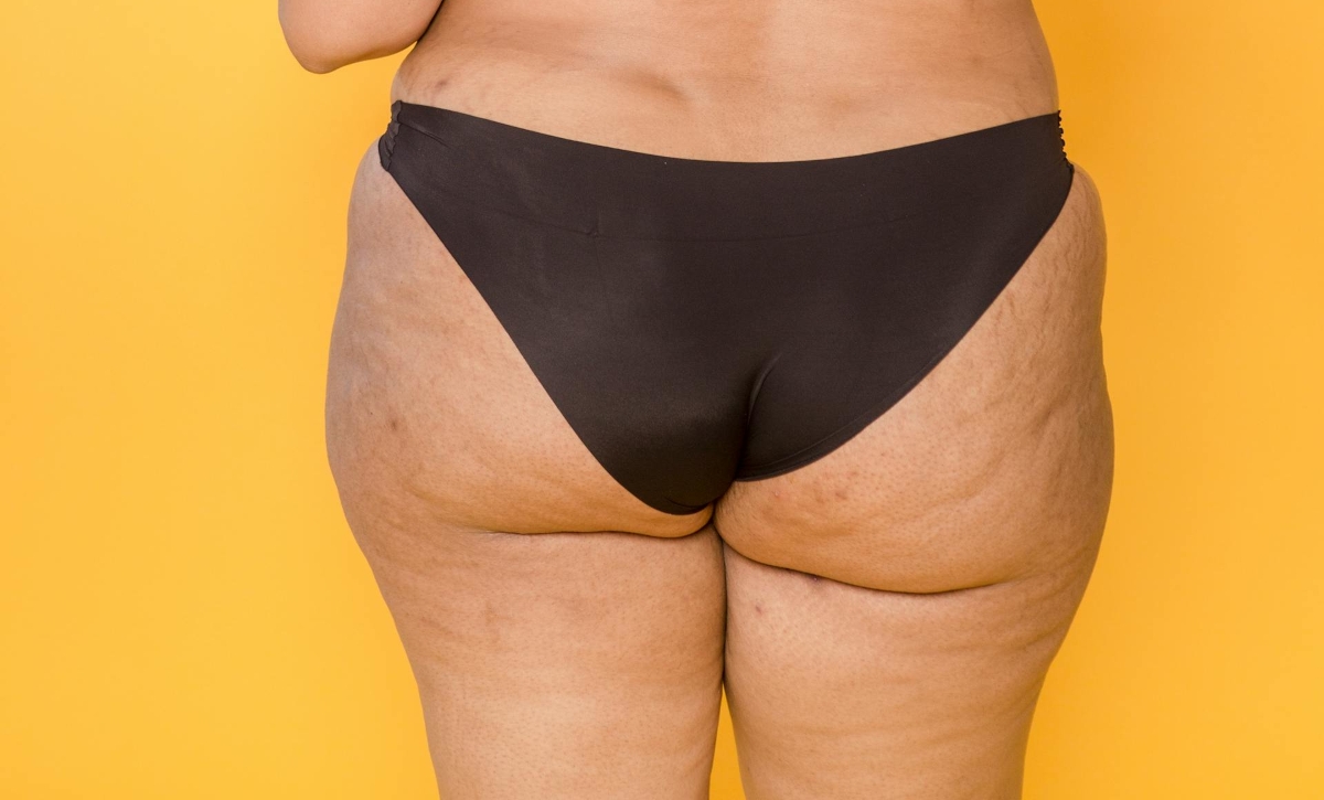 réduire cellulite