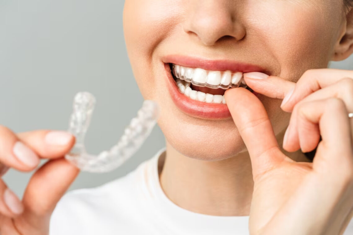 remboursement invisalign