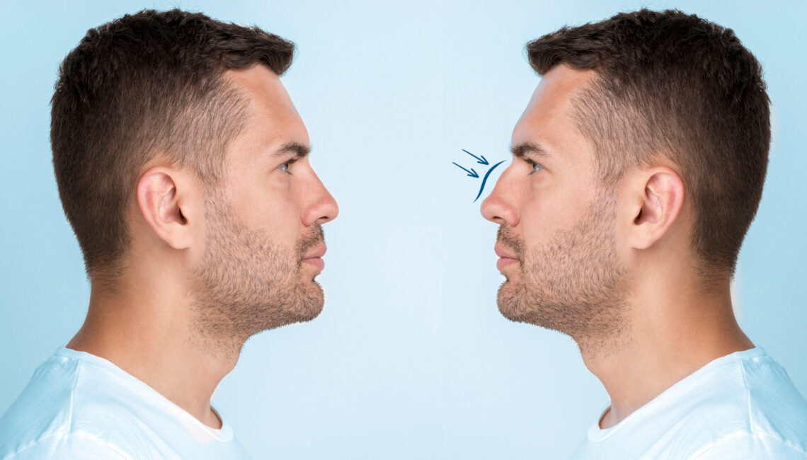rhinoplastie France