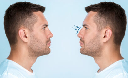 rhinoplastie France