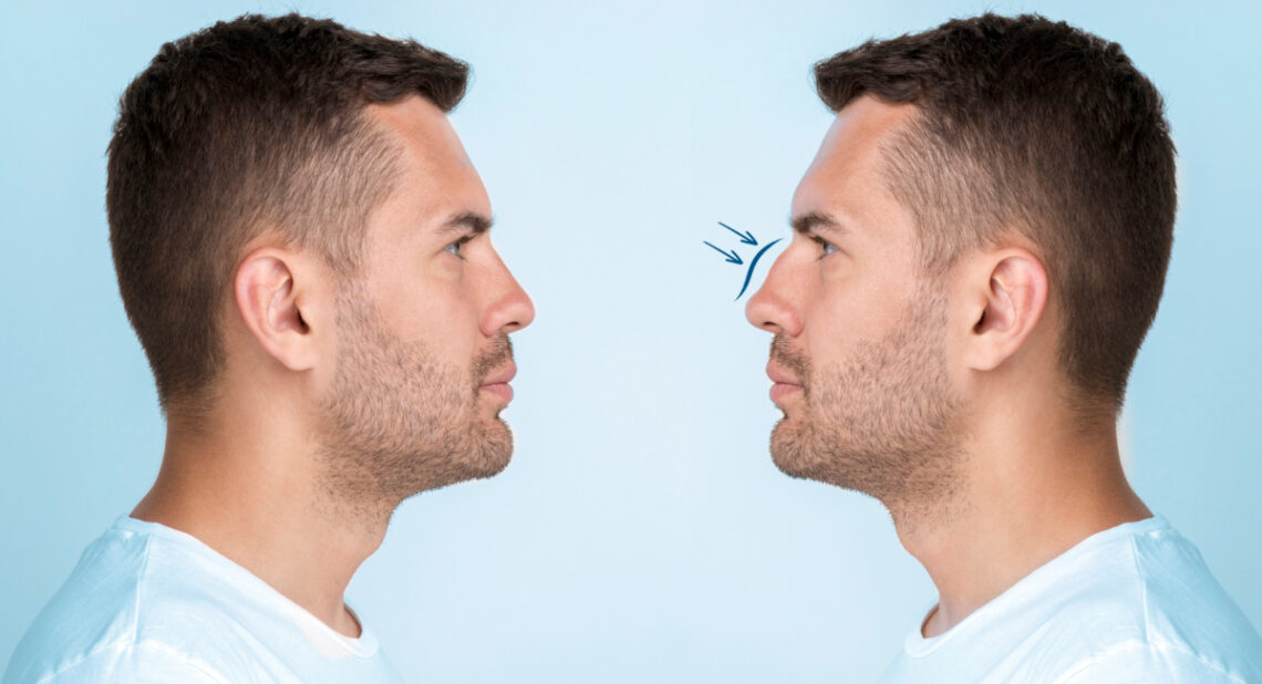 rhinoplastie France