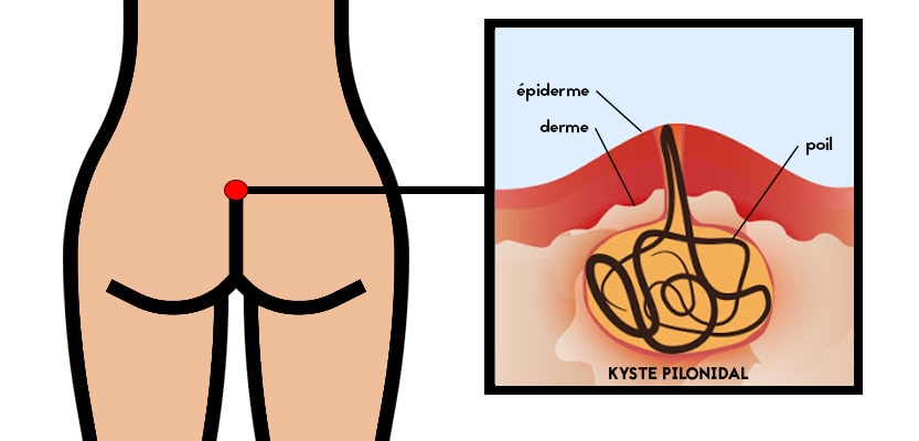 schema-kyste-pilonidal