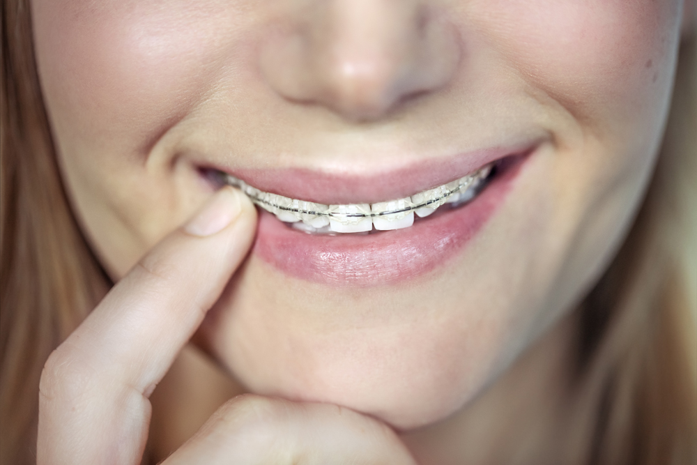 traitement orthodontique adulte